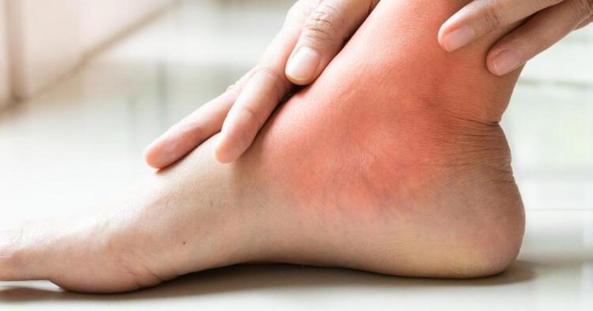 Ayak bileği burkulmasına ne iyi gelir? Burkulmuş bir ayak bileği nasıl tedavi edilir? Ayak bileği burkulmasına iyi gelen şeyler